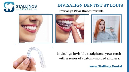 The Benefits of Invisalign Dentist Services in St Louis